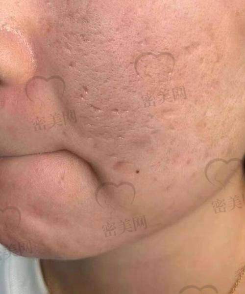 玻尿酸填充痘坑需不需要剥离处理呢？