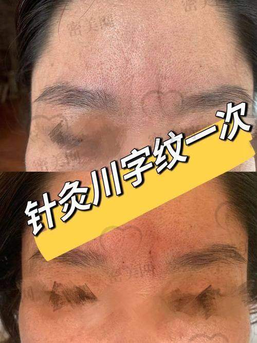 哪些人适合找李广学医生做川字纹填充？