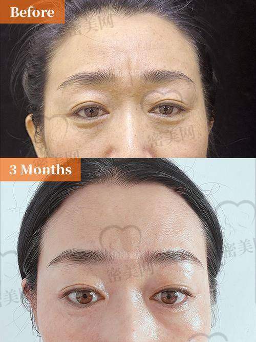 川字纹填充后成效能维持多久？是否需要反复补打？