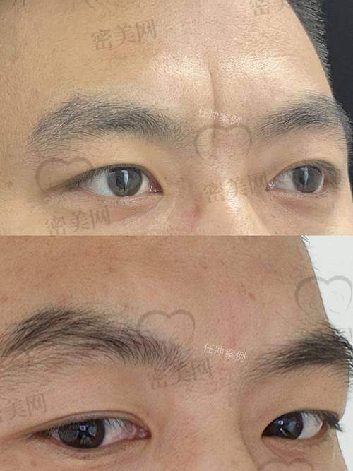 李广学医生是谁？为何大家都找他做川字纹填充？