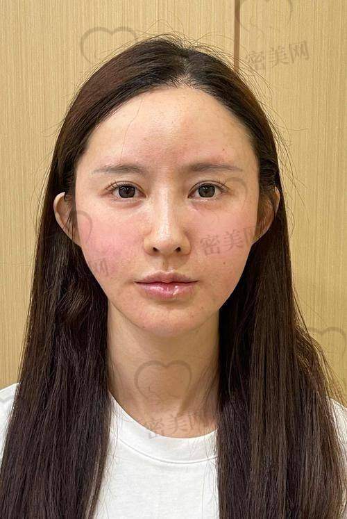单部位脂肪填充过程体验
