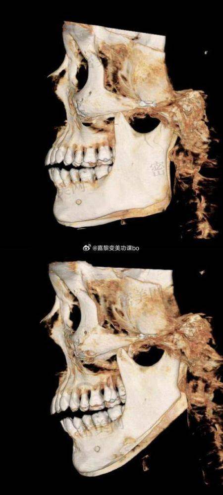 何晋龙磨骨实例大赏
