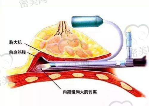 上海艺星陈成傲诺拉隆胸手术过程