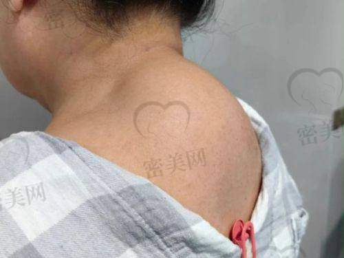 温州徐淑卿医生富贵包手术价格实惠，8800元起真的不贵
