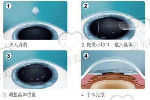 北京华德眼科医院价格透明合理，比想象中要亲民