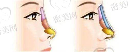 张宏医生技术特点：