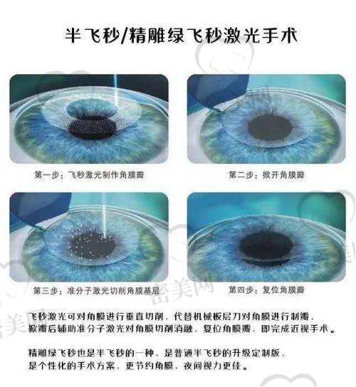 白内障手术：从基础到高端镜片，价格全方面公开