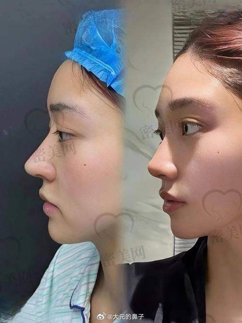 文丰做鼻子的修复期真的特别短吗？术后几天能出门见人？