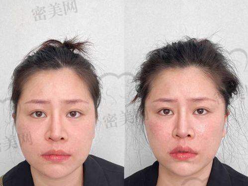 哲晨子玻尿酸成分剖析：含量标准，分子量分级是亮点