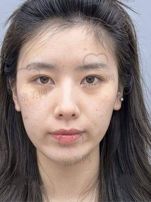 哲晨子玻尿酸的适用场景及人群：不止补水那么简单