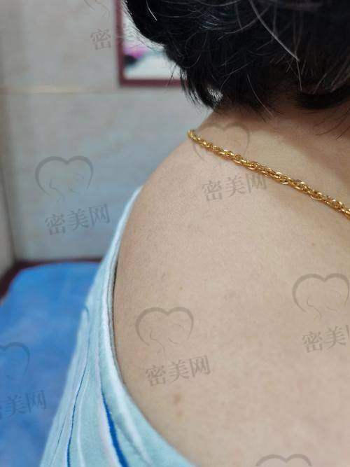徐淑卿医生富贵包手术实例反馈：线条立刻清晰，身姿“立正”