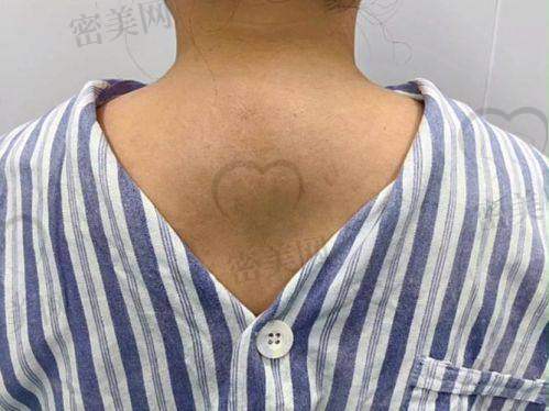 温州徐淑卿医生富贵包手术技术强，实测修复快、几乎微痛