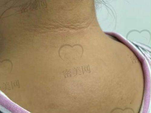 总结：温州徐淑卿做富贵包手术真实有效，技术靠谱、修复快、价格亲民