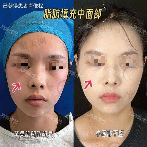 填充成效能“保鲜”多久
