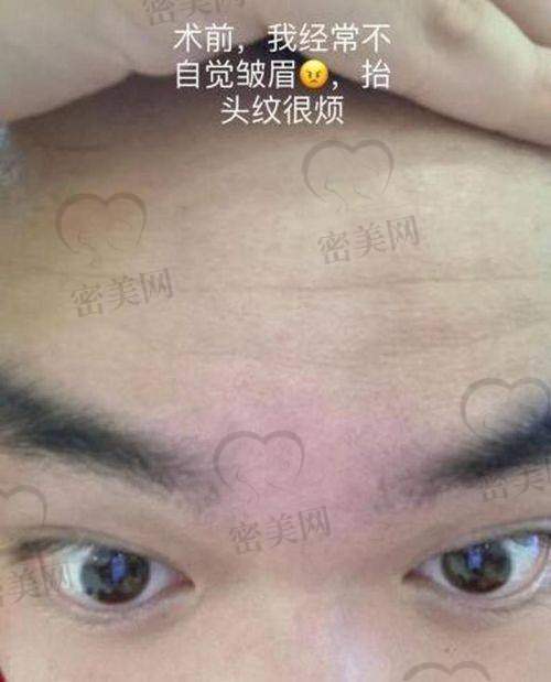 去除抬头纹的费用情况