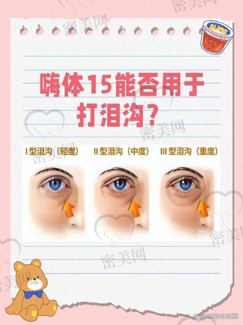 泪沟消除术后保养妙招