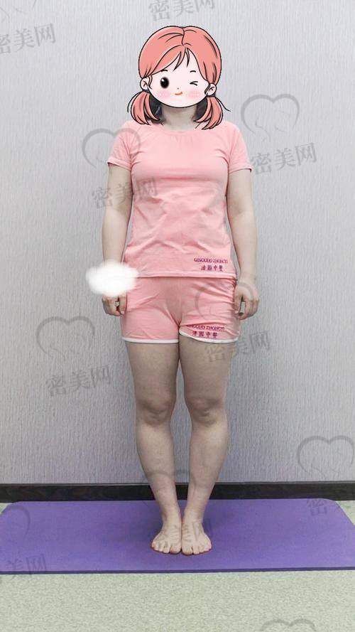 上海丽质整形美容医院卢九宁直腿术：真人实例见证奇迹