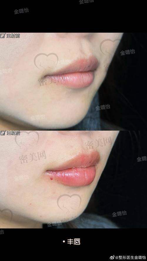 肿胀时间：刚丰完唇肿多久