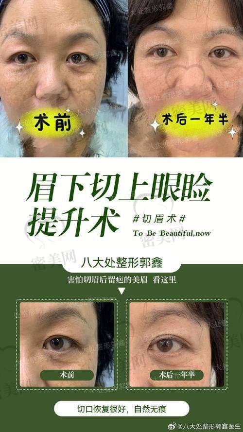 上海海华医院安洪宾手术实例：真实变得更美大揭秘