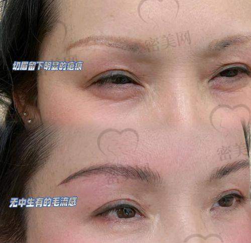 上海海华医院杨军眼周年轻化手术：30000 元起的眼部焕活盛宴