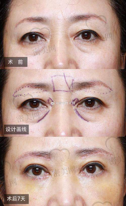 探秘上海海华医院安洪宾：医术不错的眼周魔法师