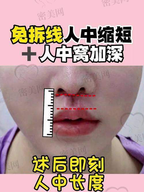 上海丽质卢九宁人中手术：12800 元的变得更美奇迹价格