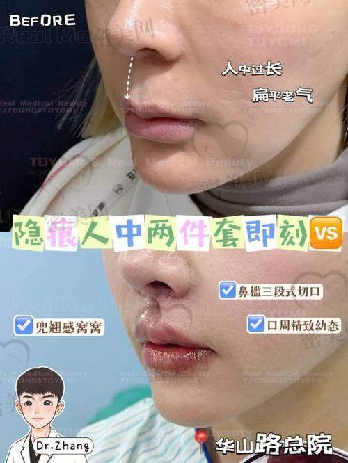 上海丽质卢九宁人中手术：口碑爆棚的美丽见证
