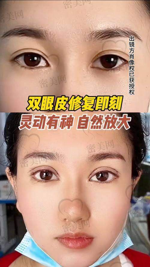 王衡健双眼皮修复实例一览：“逆袭大片”震撼上演