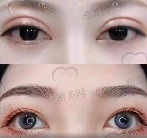 王衡健双眼皮修复收费标准：性价比极高的“宝藏套餐”