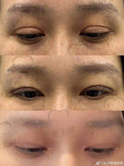 细腻缝合技术是怎么实现“修复快”的关键？