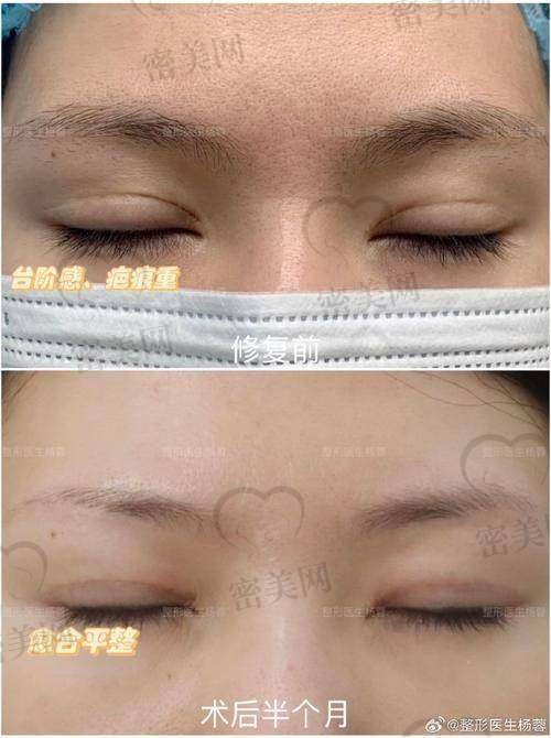 术后修复，惊喜不断