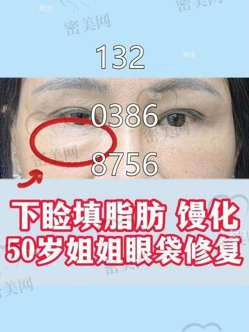眼袋修复全流程攻略：从术前到术后护理由你负责