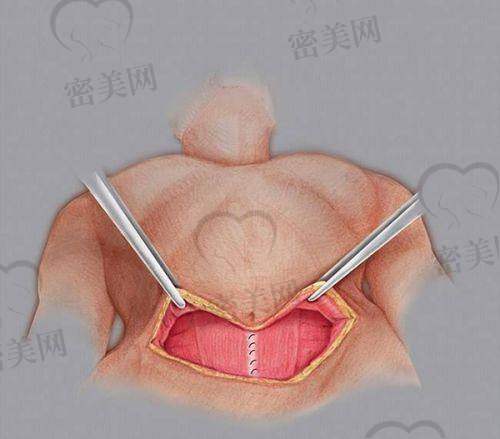 赵鹏筋膜提升术价格透明公开,具体费用明细如下
