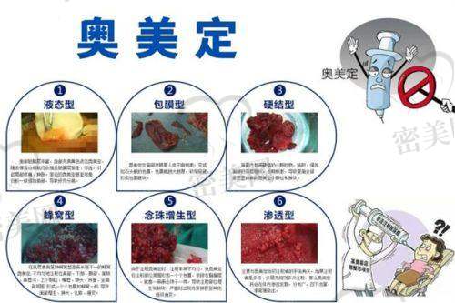 武汉五洲微整形价格列表:玻尿酸/肉毒素一览无余