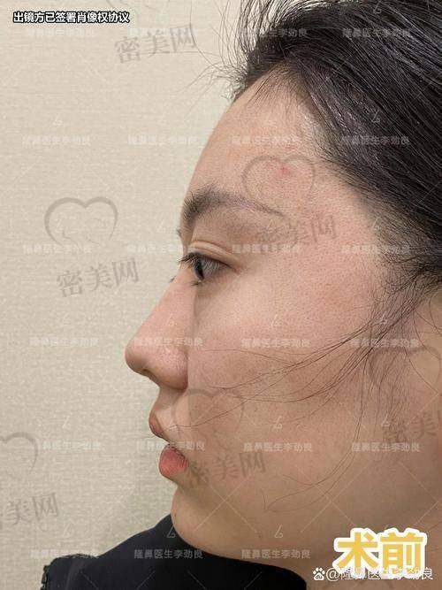牛永敢做鼻子多少钱？价格透明，非虚高