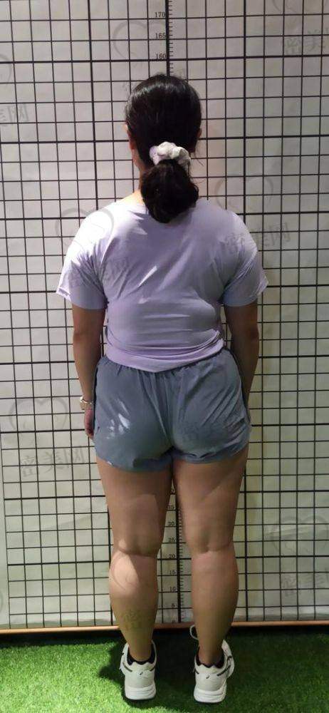 深圳军科医疗美容门诊部：三十载老机构，Bodytite显微吸脂
