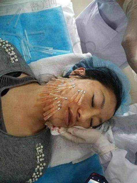 广州韩妃风筝小拉皮对比其他传统提拉方式有哪些优势？