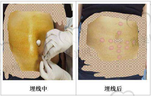 为何选择广州韩妃做风筝小拉皮而非其他医院