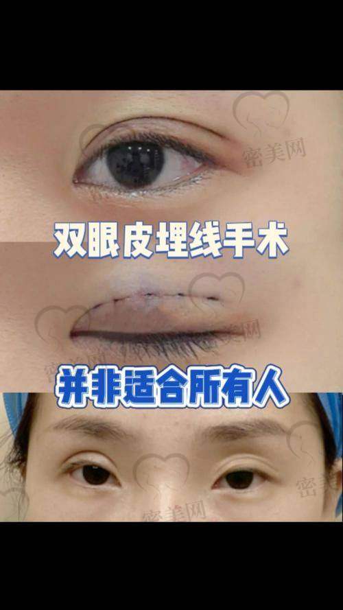 精良医生张金娥：双眼皮界的魔法师
