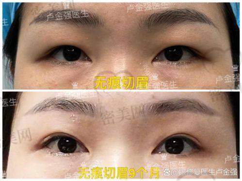 天津紫洁张金娥：6800 元起的眼周年轻化“钞能力”