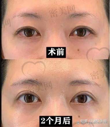 天津紫洁医疗美容郭栓全：6800 元开启眼周逆龄“低价宝藏”之旅