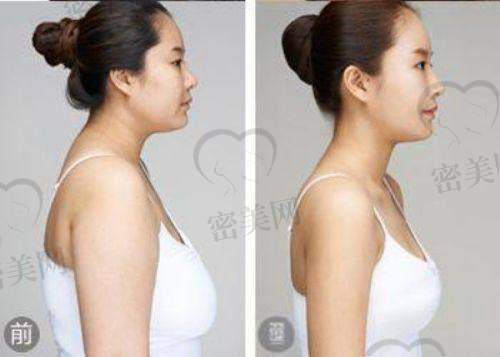 上海海华医院：巨乳缩小手术的优质平台