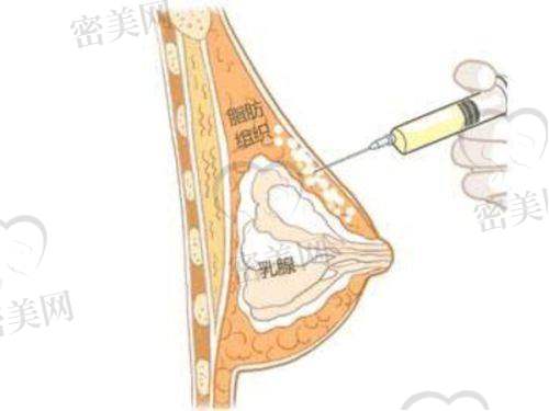 隆胸、自体脂肪填充,两种方式怎么选?韩艺来胸部整形解析
