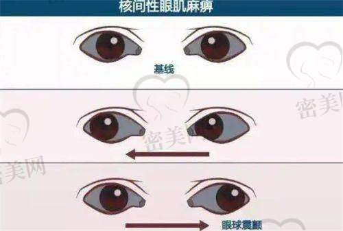 爱尔眼科成品VS定制义眼片怎么选？一分钱一分货真的可信吗？