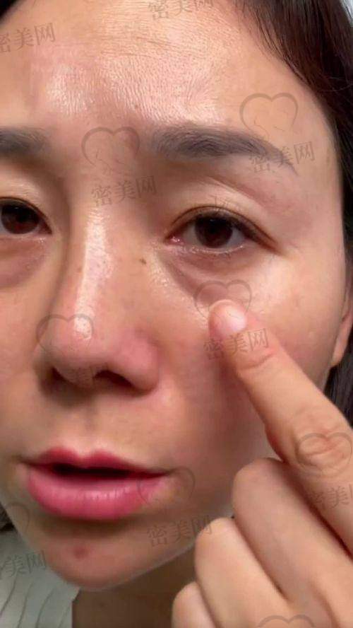 口碑爆棚：天津紫洁任晋峰祛眼袋获赞无数