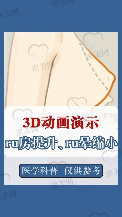 上海海华医院李营巨乳缩小：患者口碑见证实力