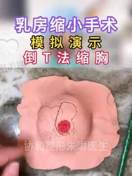 上海海华医院李营：40000 元起巨乳缩小的高性价比之选