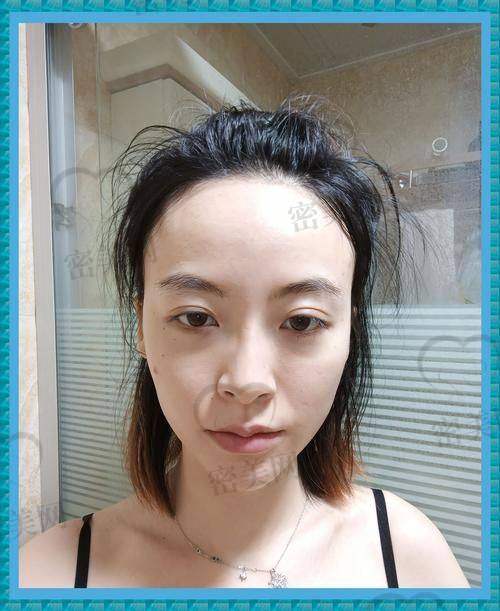 玻尿酸填充成效能维持多久？