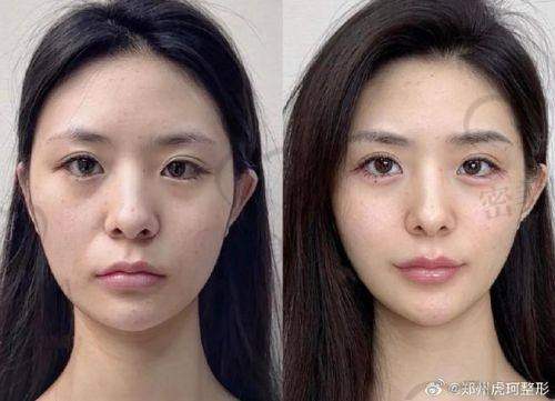 五、如何理性选择进口玻尿酸？