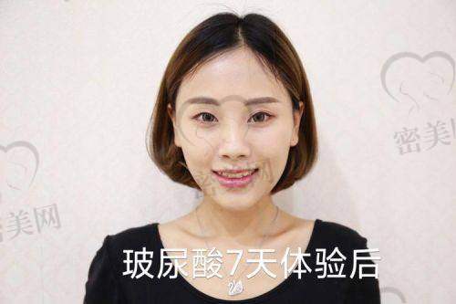 玻尿酸填充下巴有啥成效？